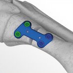 Metafix Open Wedge